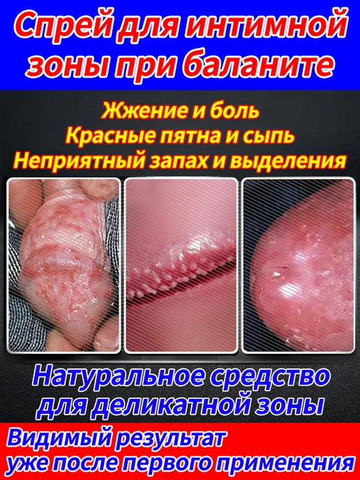 Интимный спрей для применения при баланите, вариант